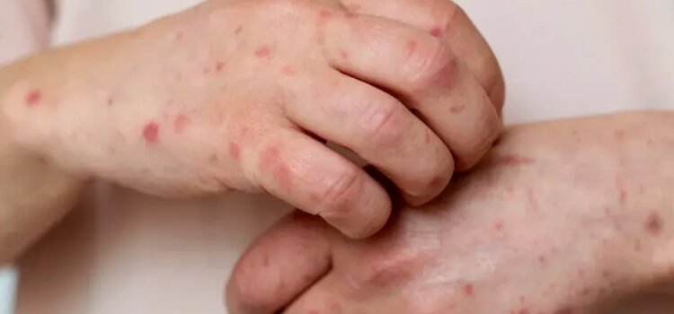 Jalisco activa cerco epidemiológico tras detectar otro caso de sarampión